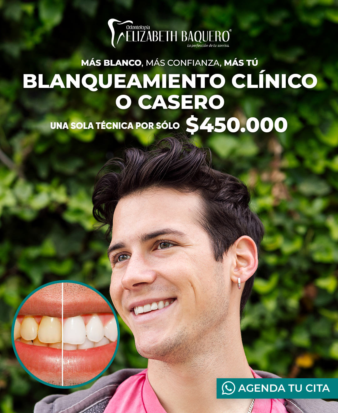Promoción de blanqueamiento casero o clínico por 450.000 pesos