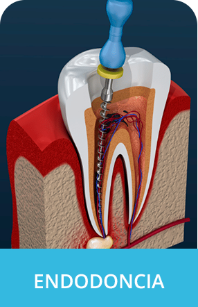 Tratamiento de endodoncia en Odontología Elizabeth Baquero